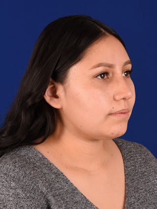 Female Rhinoplasty Before & After Gallery - Patient 17363822 - Image 4