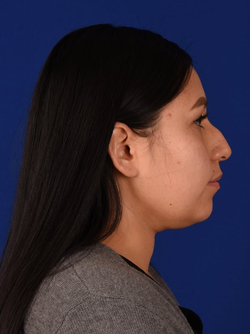 Female Rhinoplasty Before & After Gallery - Patient 17363822 - Image 5