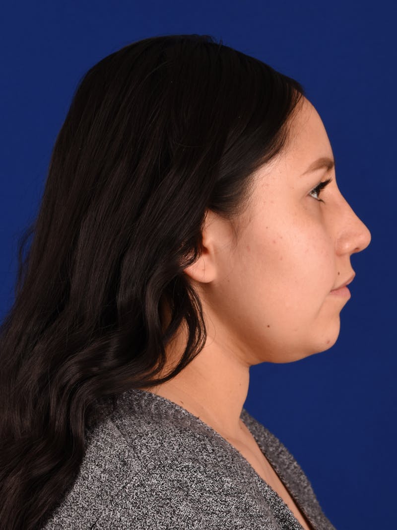 Female Rhinoplasty Before & After Gallery - Patient 17363822 - Image 6