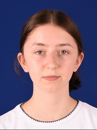 Female Rhinoplasty Before & After Gallery - Patient 17363823 - Image 1
