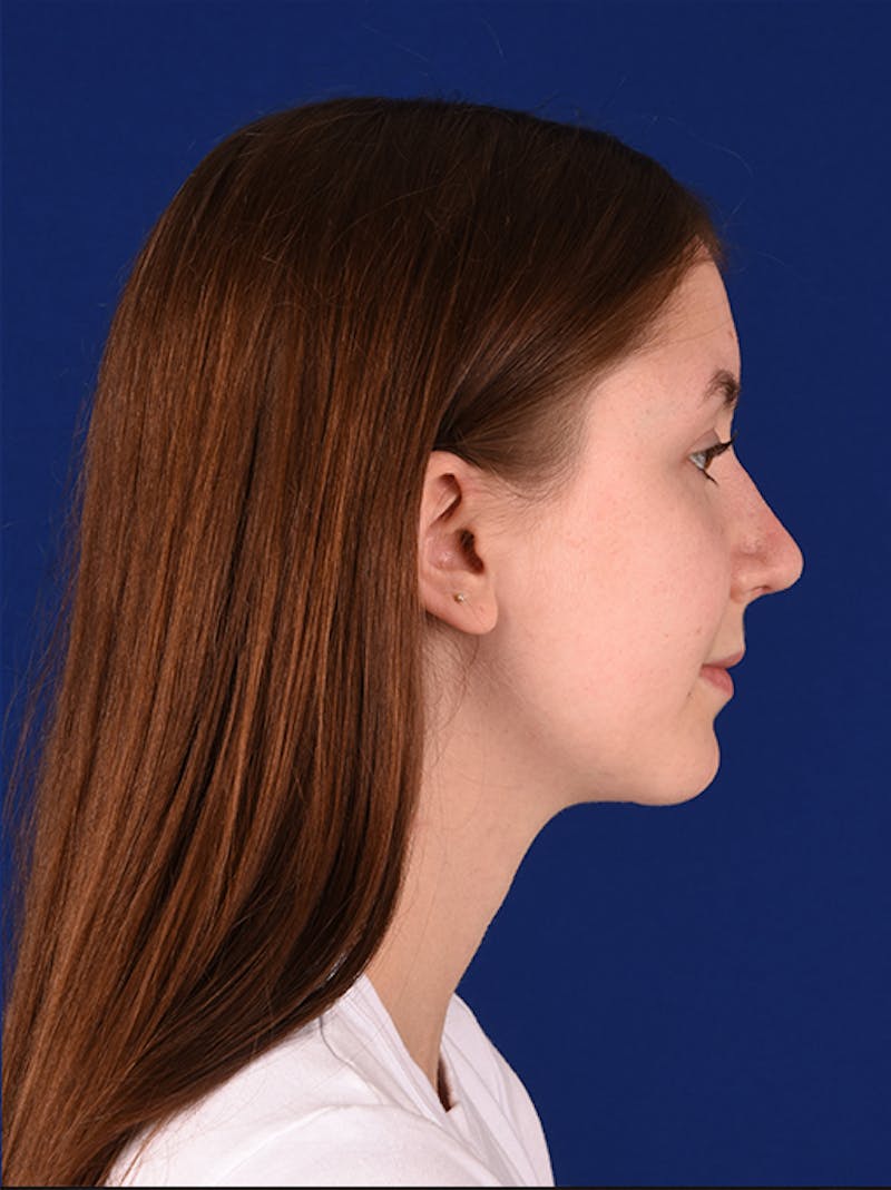 Female Rhinoplasty Before & After Gallery - Patient 17363823 - Image 6
