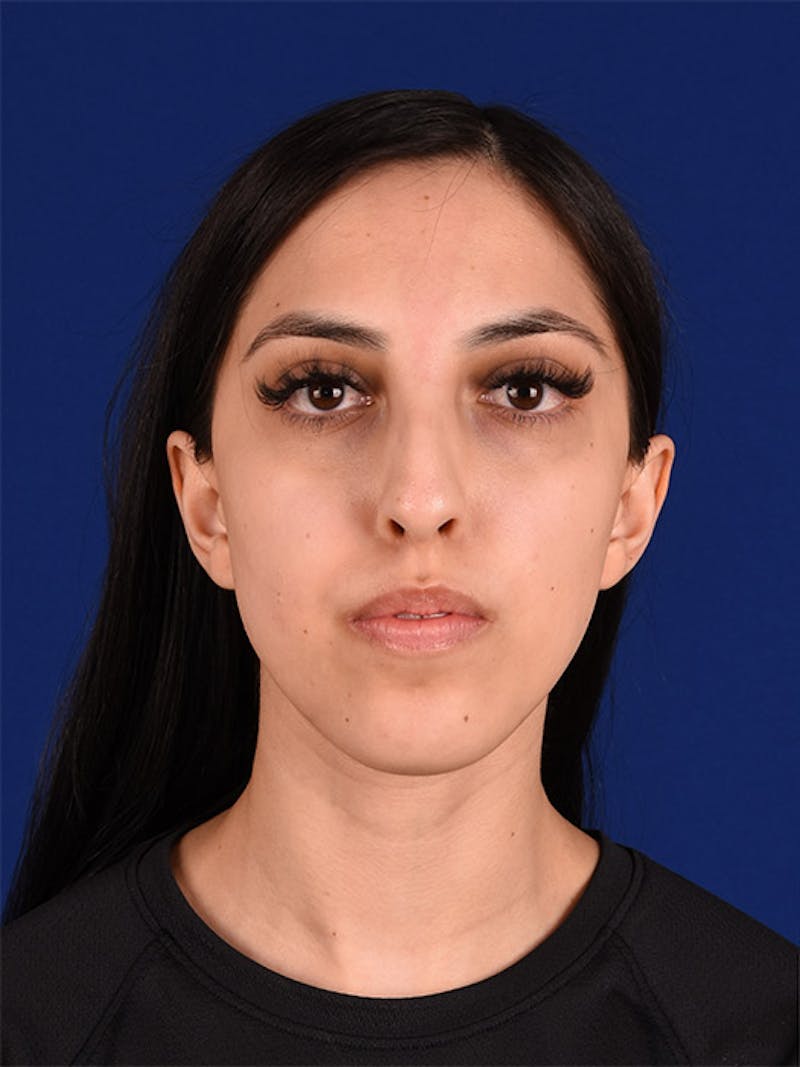 Female Rhinoplasty Before & After Gallery - Patient 17363824 - Image 1