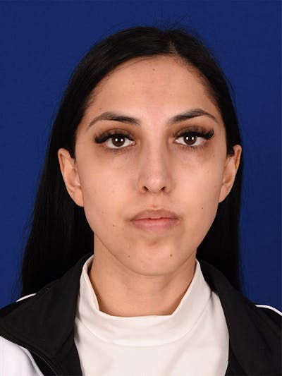 Female Rhinoplasty Before & After Gallery - Patient 17363824 - Image 2