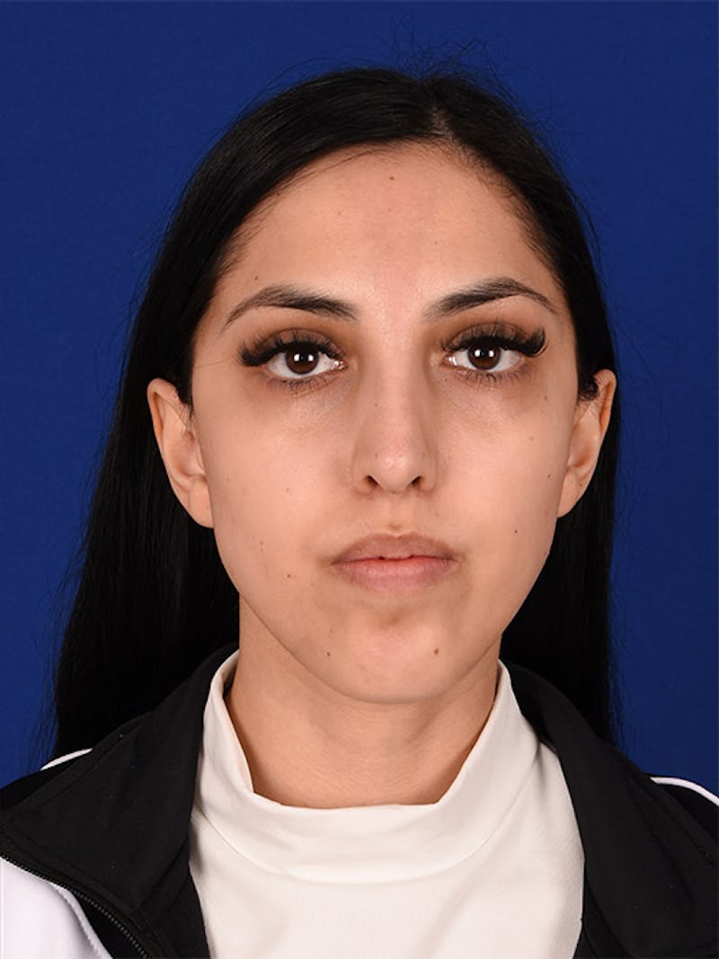 Female Rhinoplasty Before & After Gallery - Patient 17363824 - Image 2