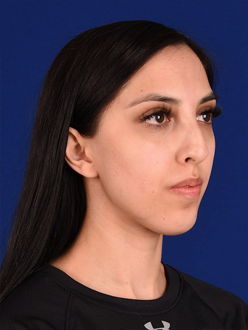 Female Rhinoplasty Before & After Gallery - Patient 17363824 - Image 3