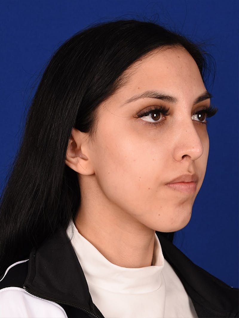 Female Rhinoplasty Before & After Gallery - Patient 17363824 - Image 4