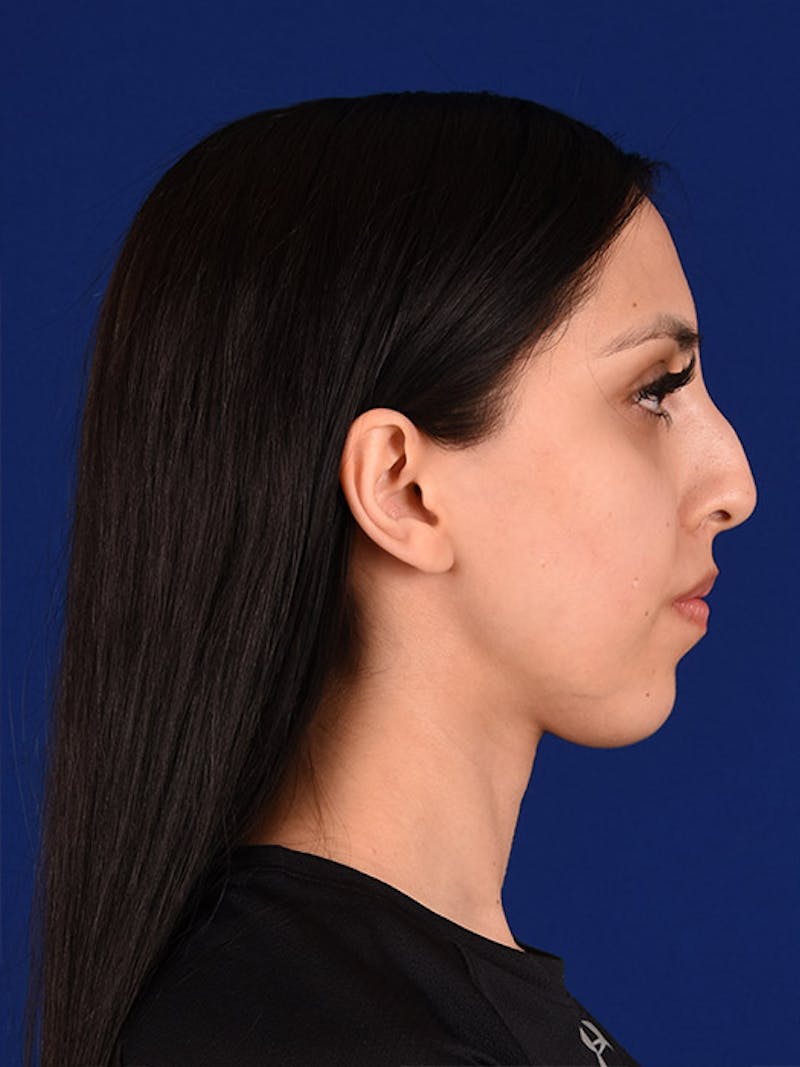 Female Rhinoplasty Before & After Gallery - Patient 17363824 - Image 5