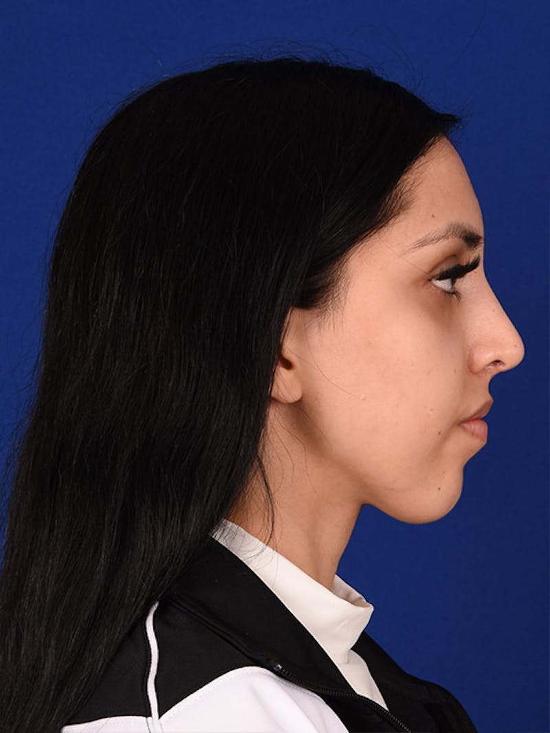 Female Rhinoplasty Before & After Gallery - Patient 17363824 - Image 6