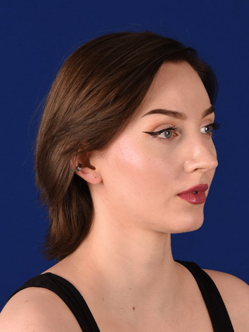 Female Rhinoplasty Before & After Gallery - Patient 17363825 - Image 3