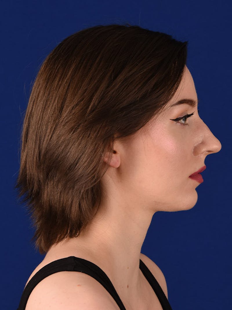 Female Rhinoplasty Before & After Gallery - Patient 17363825 - Image 5