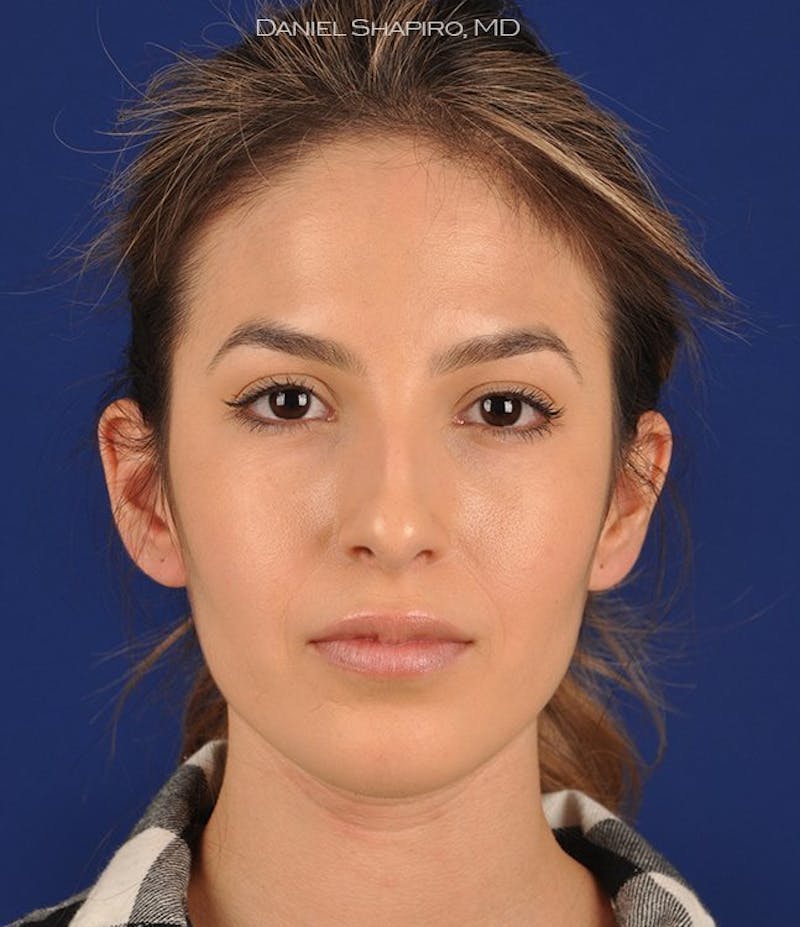 Female Rhinoplasty Before & After Gallery - Patient 17363826 - Image 1