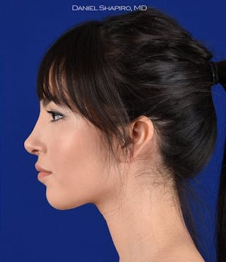 Female Rhinoplasty Before & After Gallery - Patient 17363826 - Image 6
