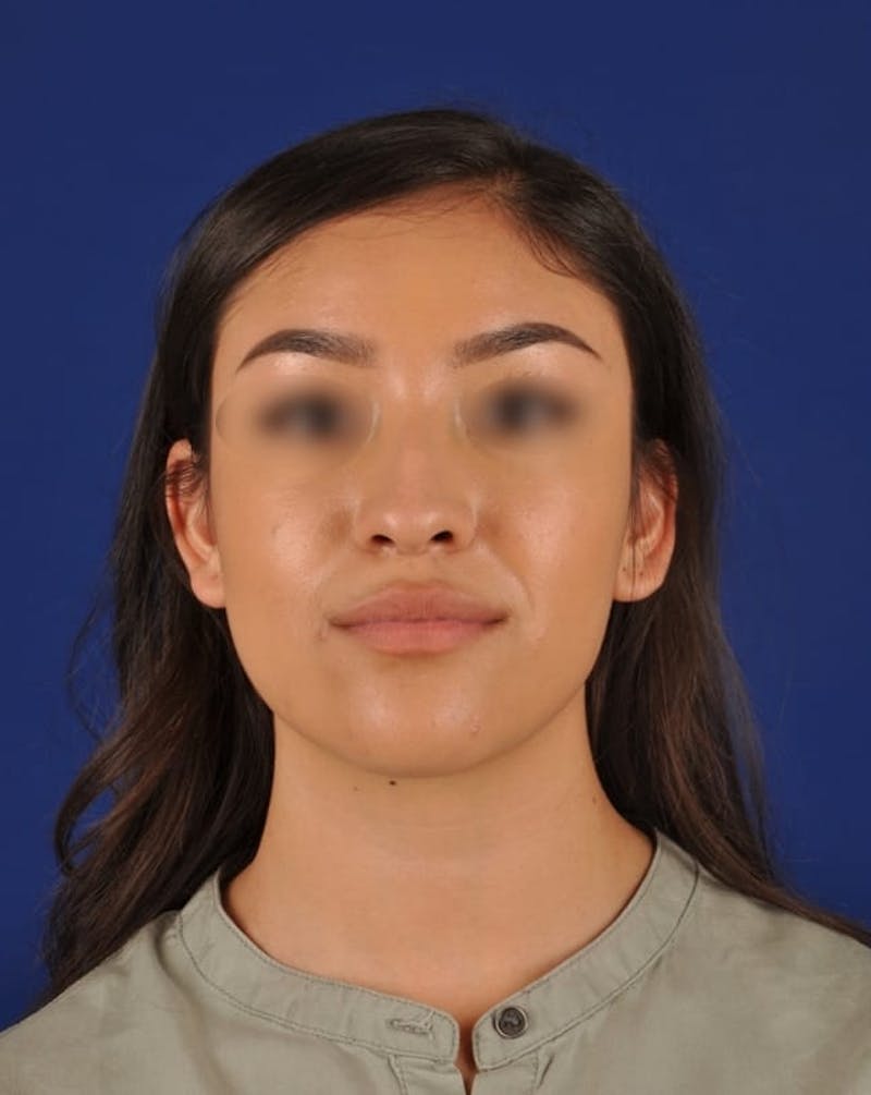 Female Rhinoplasty Before & After Gallery - Patient 17363827 - Image 1