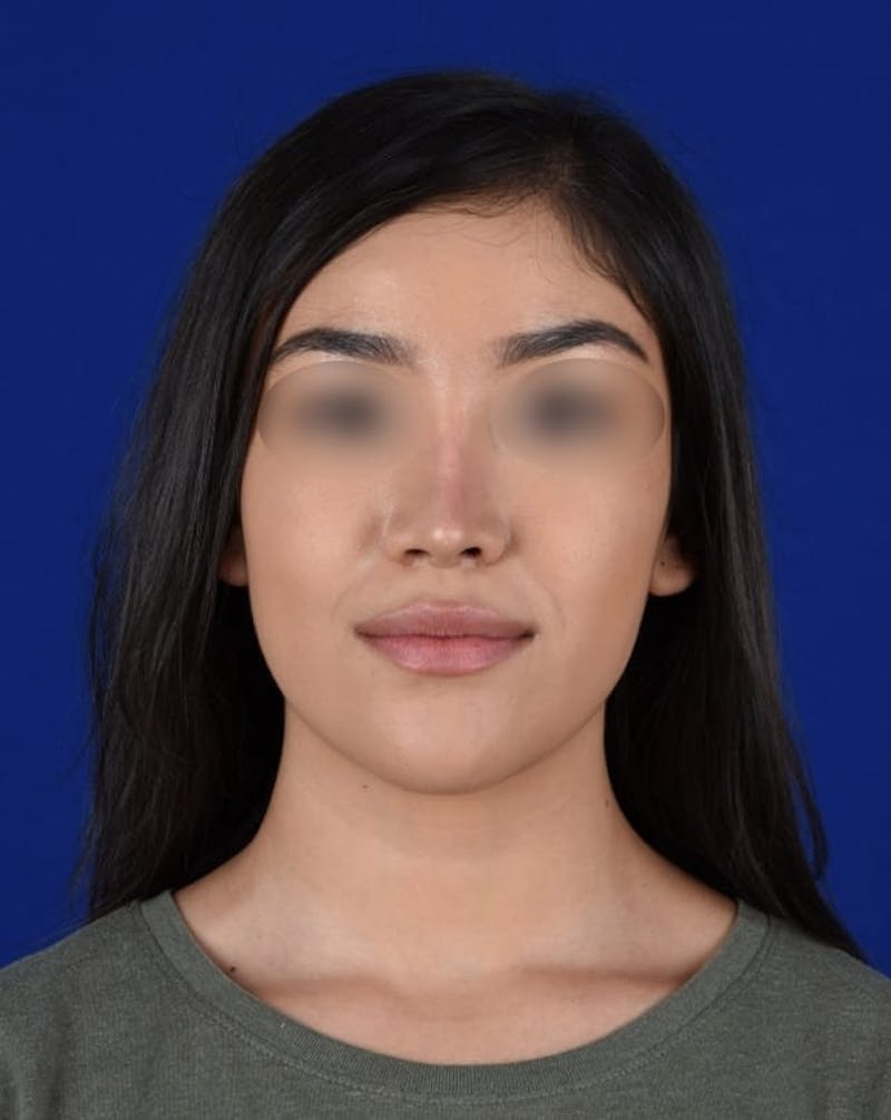 Female Rhinoplasty Before & After Gallery - Patient 17363827 - Image 2