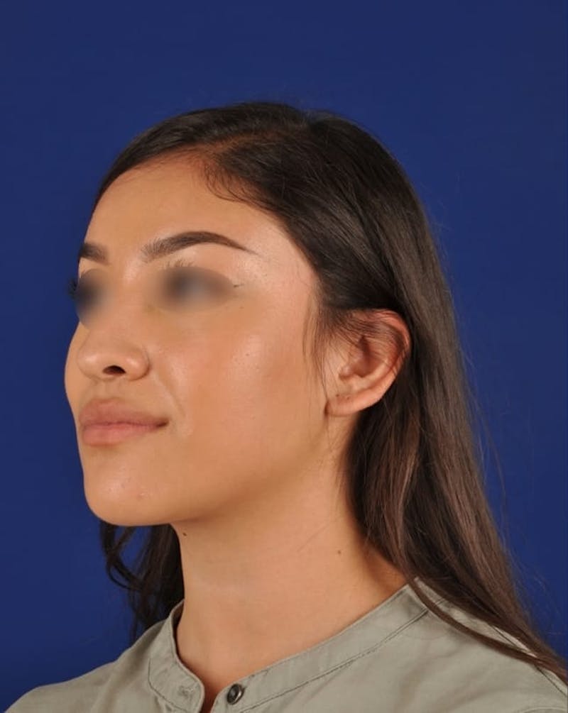 Female Rhinoplasty Before & After Gallery - Patient 17363827 - Image 3