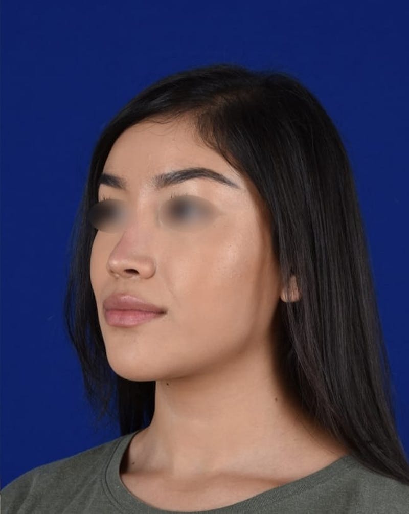 Female Rhinoplasty Before & After Gallery - Patient 17363827 - Image 4