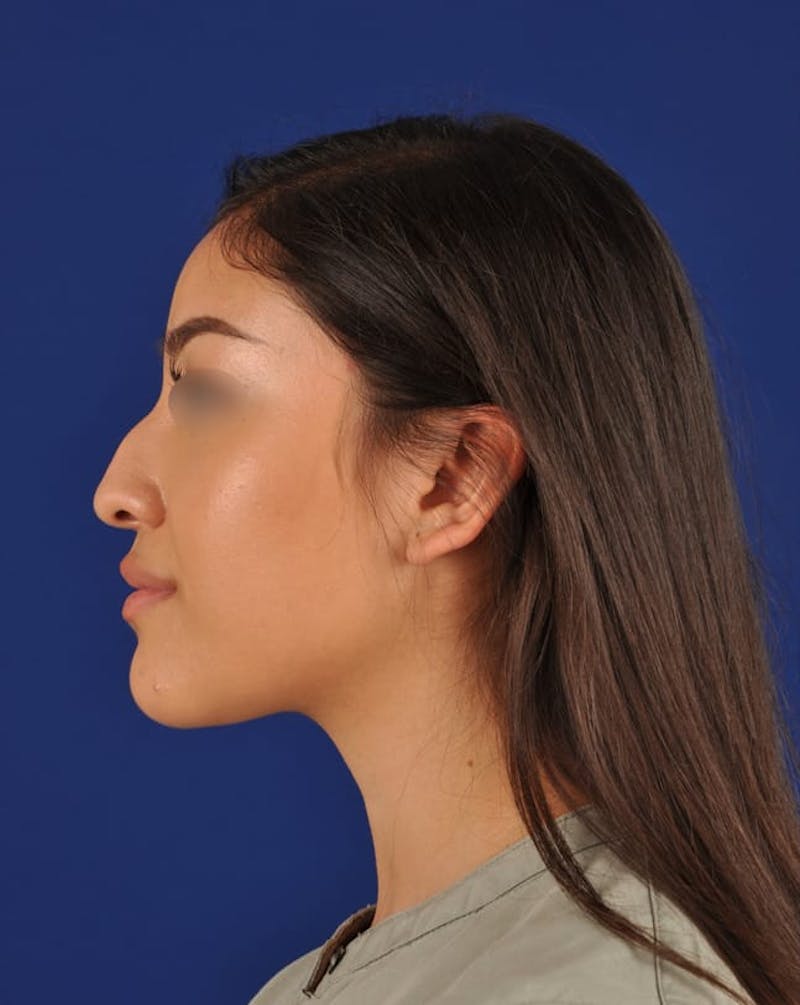 Female Rhinoplasty Before & After Gallery - Patient 17363827 - Image 5