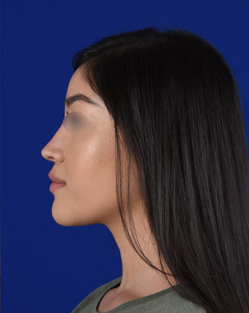 Female Rhinoplasty Before & After Gallery - Patient 17363827 - Image 6