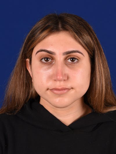 Female Rhinoplasty Before & After Gallery - Patient 17363844 - Image 2