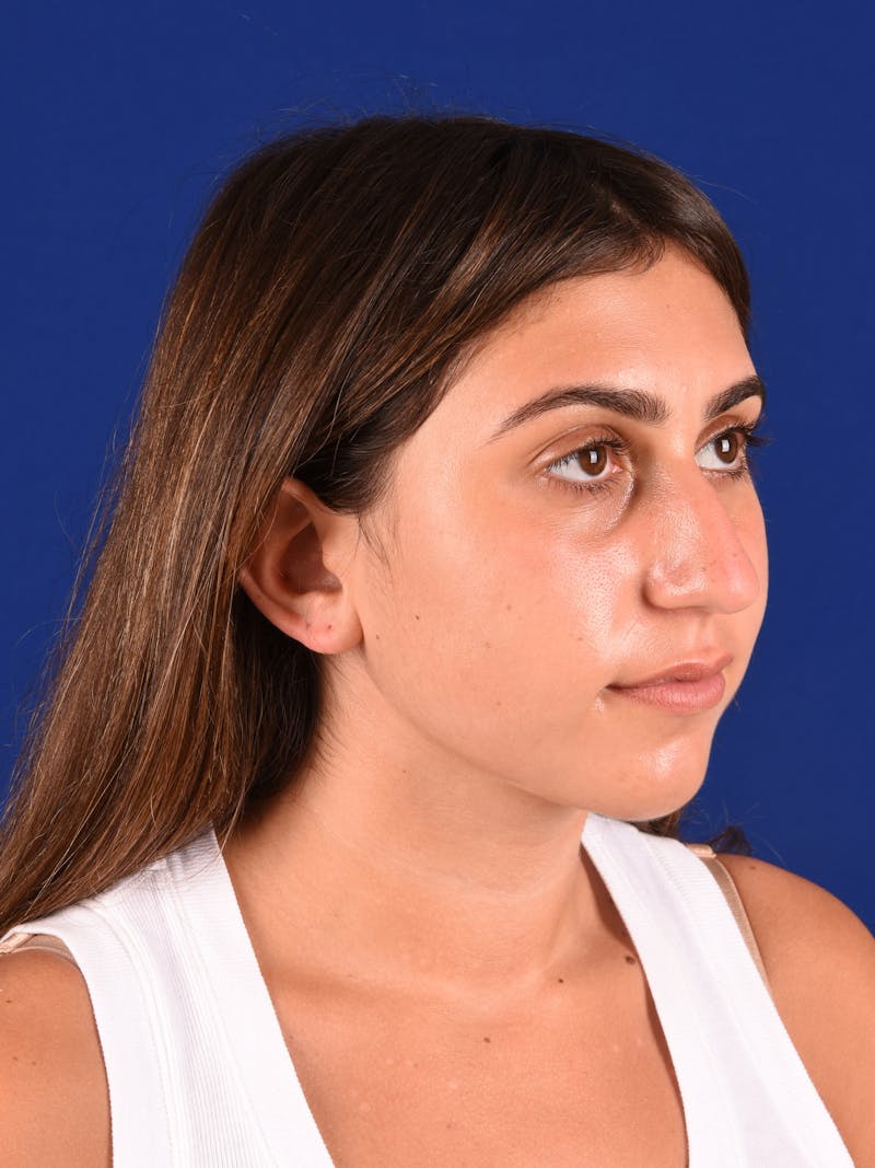 Female Rhinoplasty Before & After Gallery - Patient 17363844 - Image 3