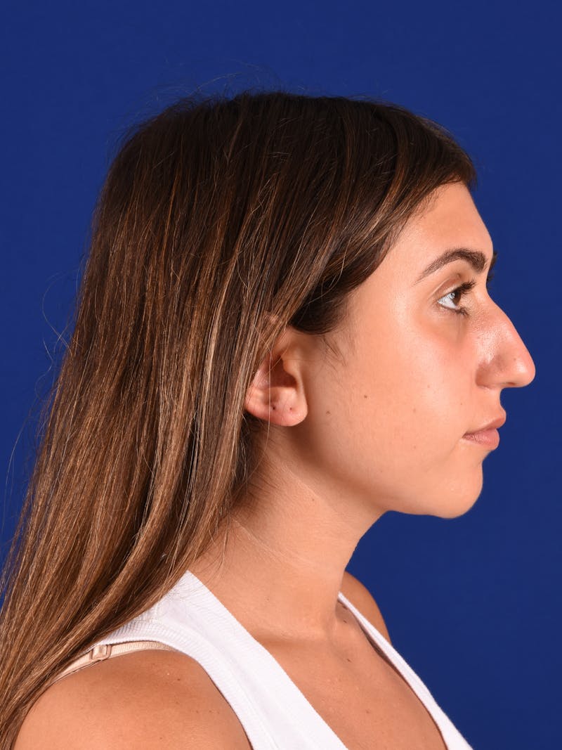 Female Rhinoplasty Before & After Gallery - Patient 17363844 - Image 5