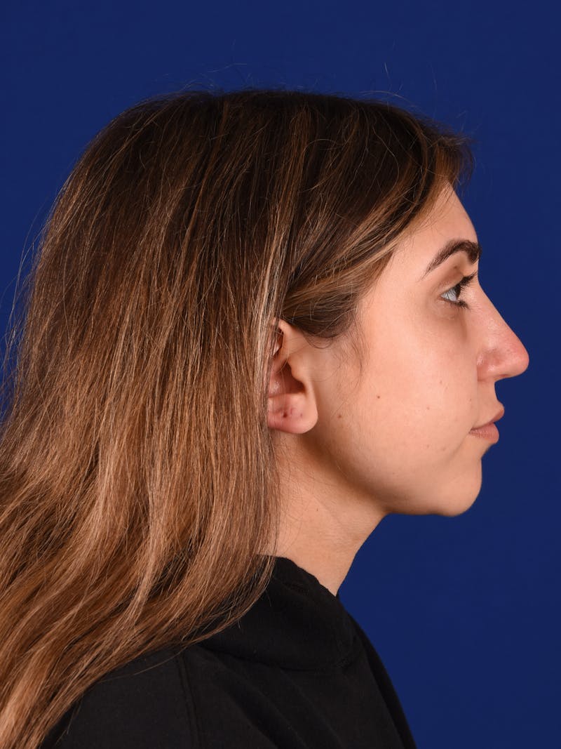 Female Rhinoplasty Before & After Gallery - Patient 17363844 - Image 6