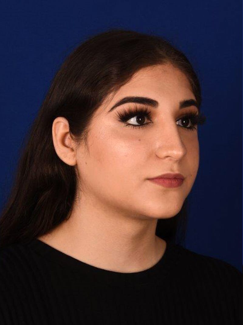 Female Rhinoplasty Before & After Gallery - Patient 17363847 - Image 4