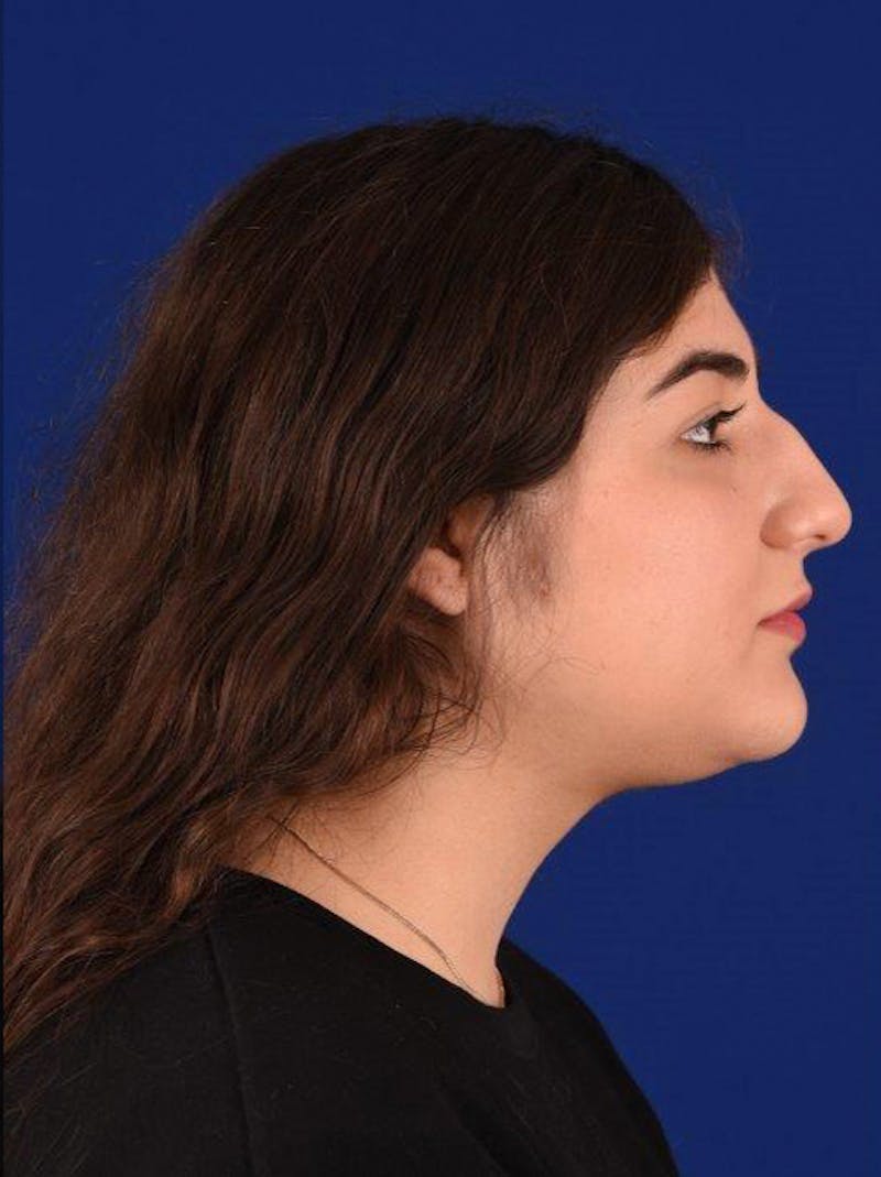 Female Rhinoplasty Before & After Gallery - Patient 17363847 - Image 5
