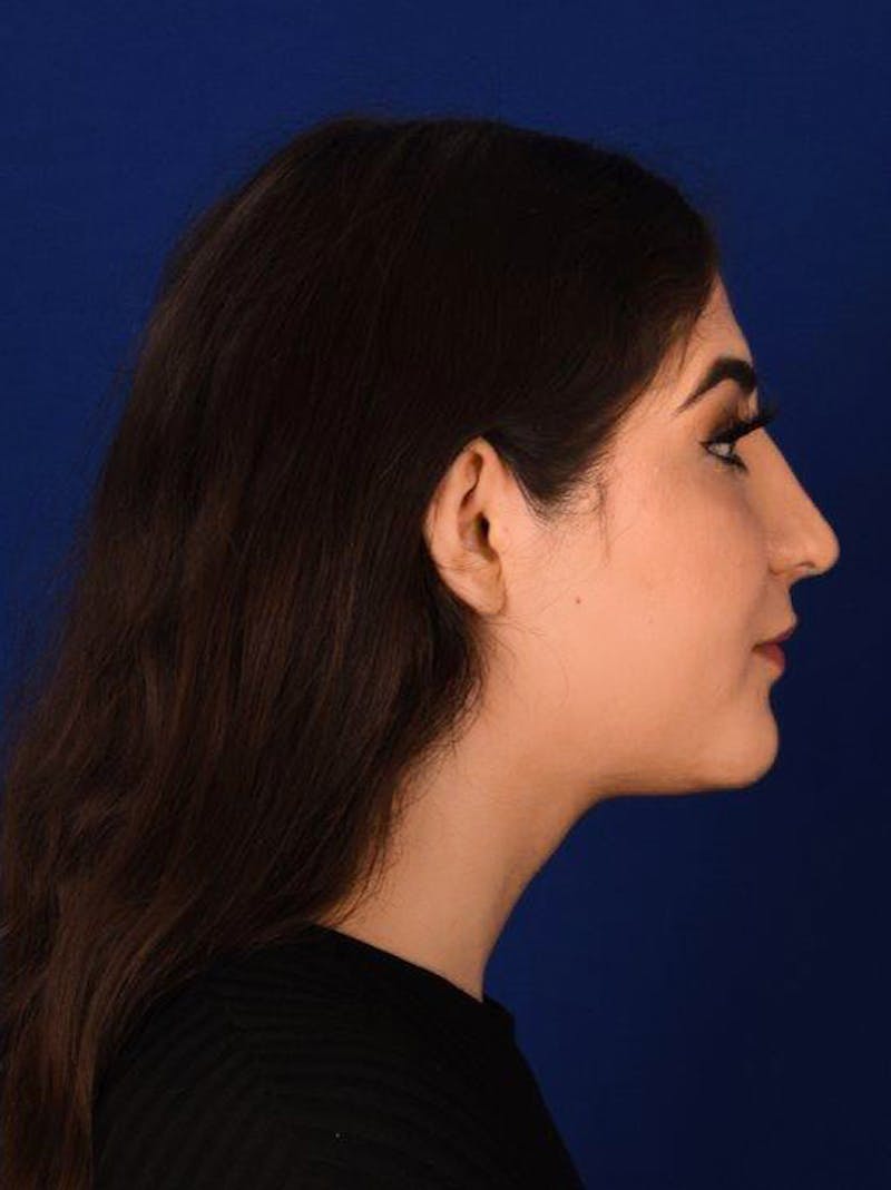 Female Rhinoplasty Before & After Gallery - Patient 17363847 - Image 6