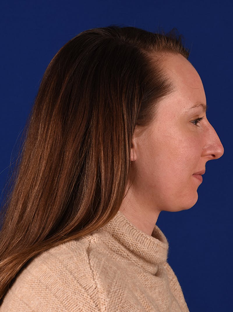Female Rhinoplasty Before & After Gallery - Patient 17363853 - Image 5