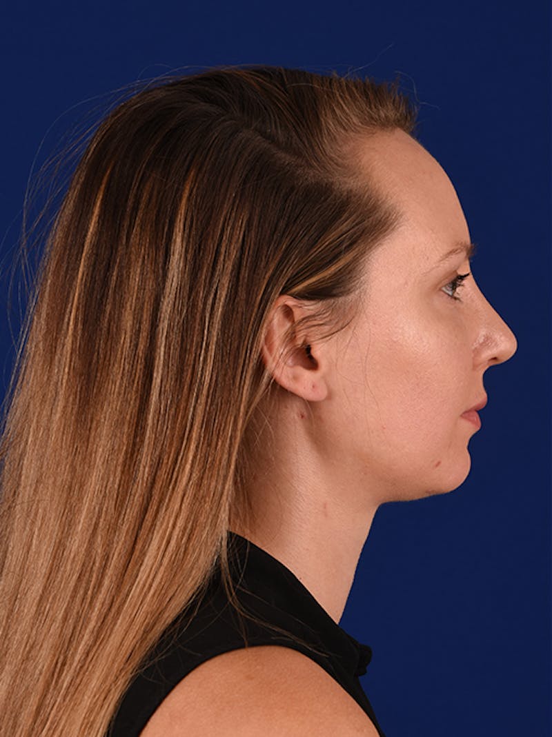 Female Rhinoplasty Before & After Gallery - Patient 17363853 - Image 6