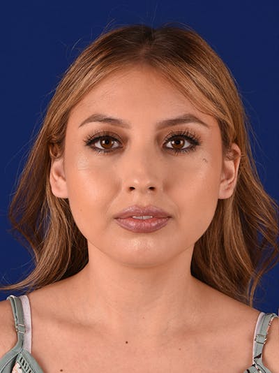 Female Rhinoplasty Before & After Gallery - Patient 17363865 - Image 1