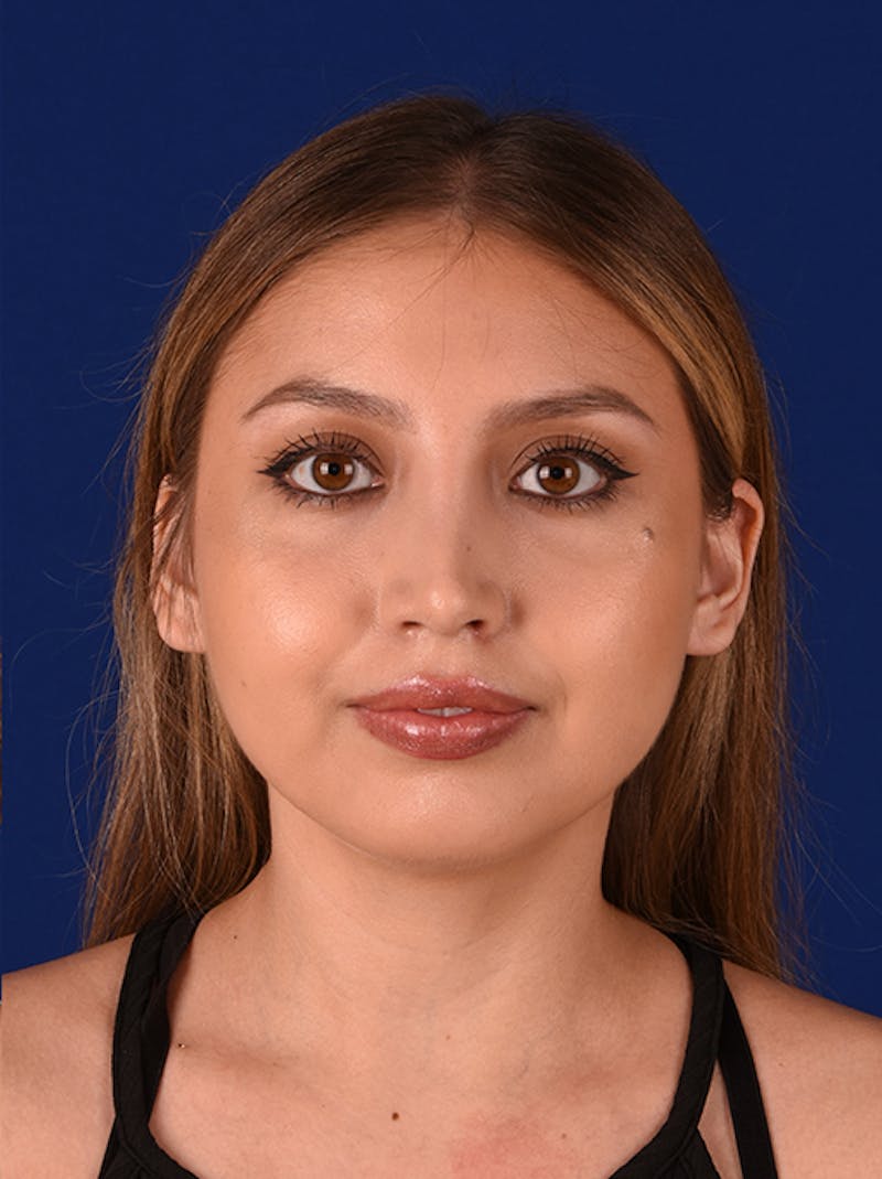 Female Rhinoplasty Before & After Gallery - Patient 17363865 - Image 2