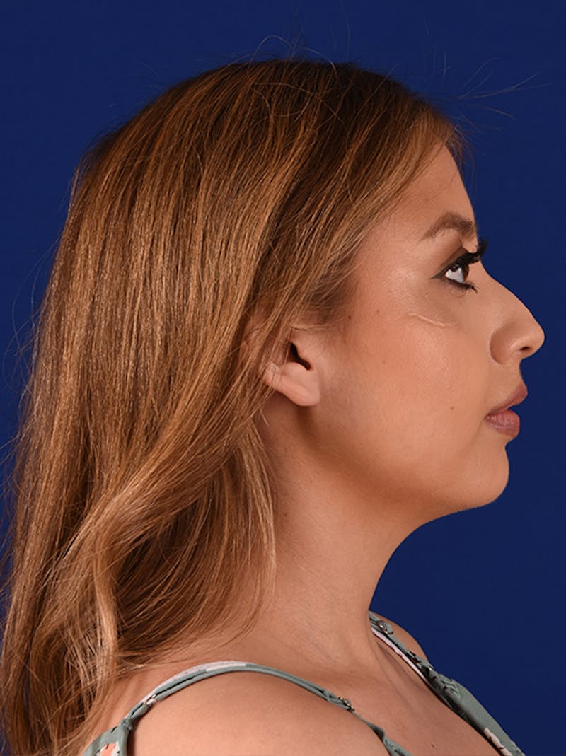 Female Rhinoplasty Before & After Gallery - Patient 17363865 - Image 5