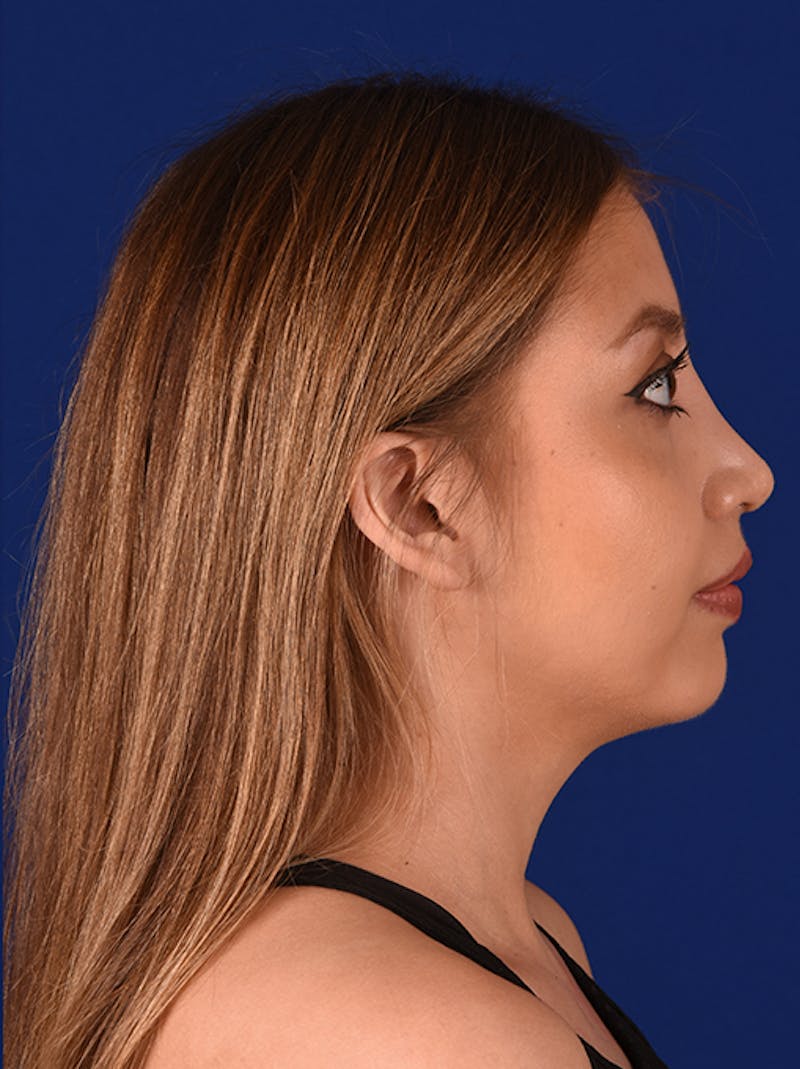 Female Rhinoplasty Before & After Gallery - Patient 17363865 - Image 6
