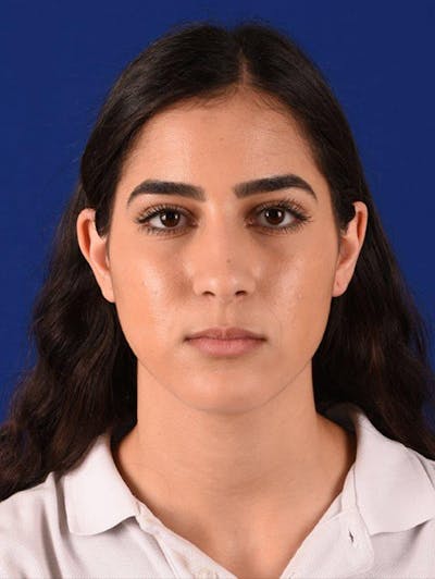 Female Rhinoplasty Before & After Gallery - Patient 17363868 - Image 1