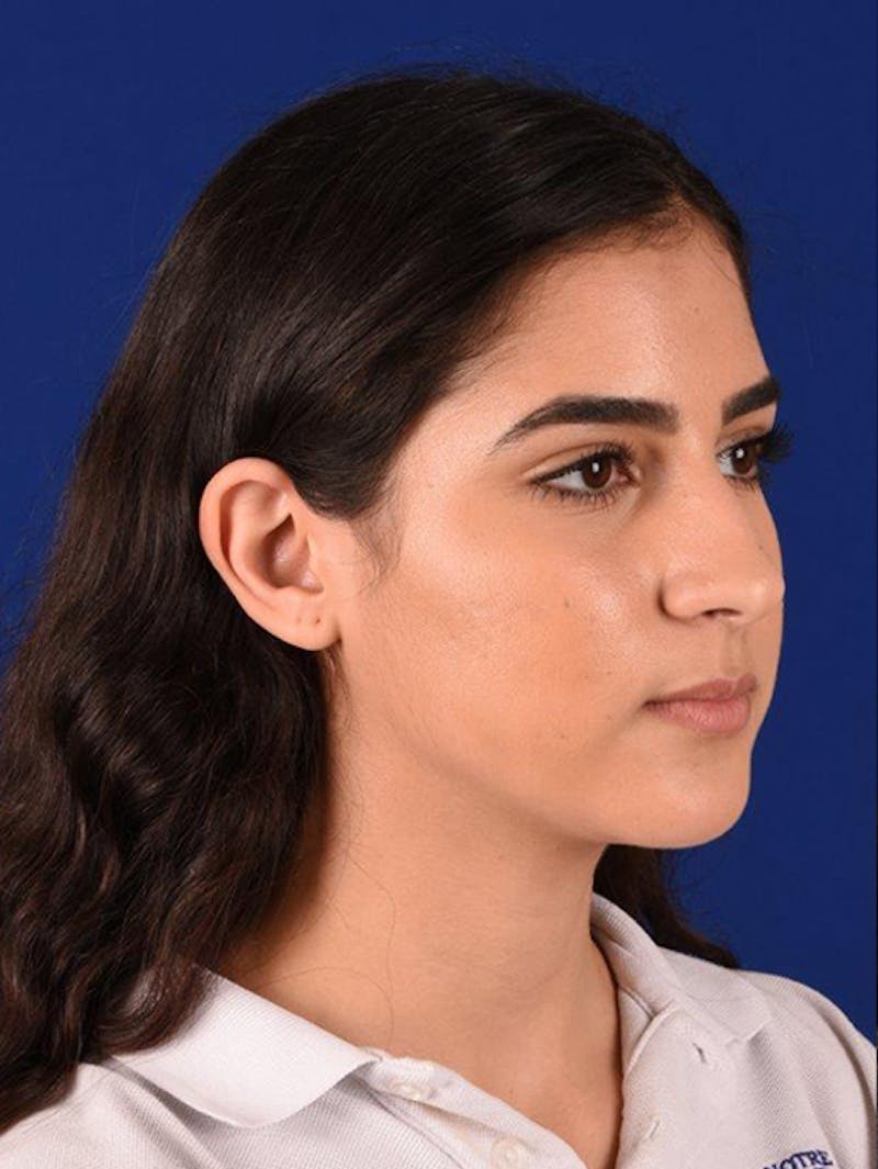 Female Rhinoplasty Before & After Gallery - Patient 17363868 - Image 3