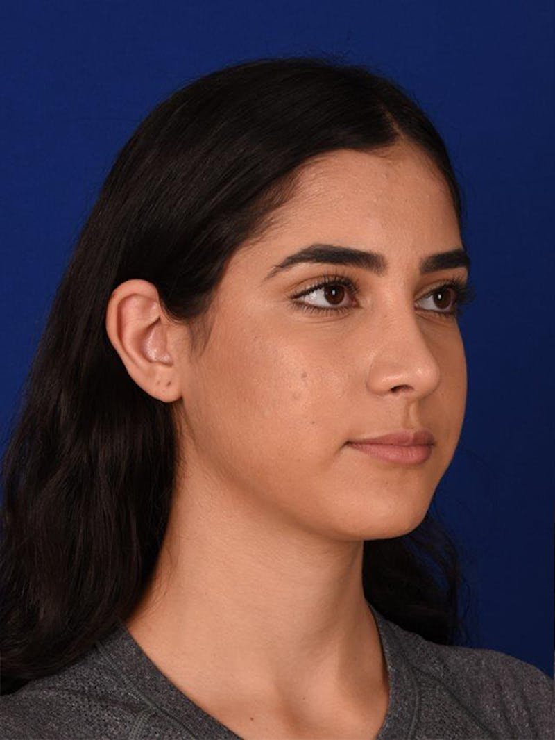Female Rhinoplasty Before & After Gallery - Patient 17363868 - Image 4