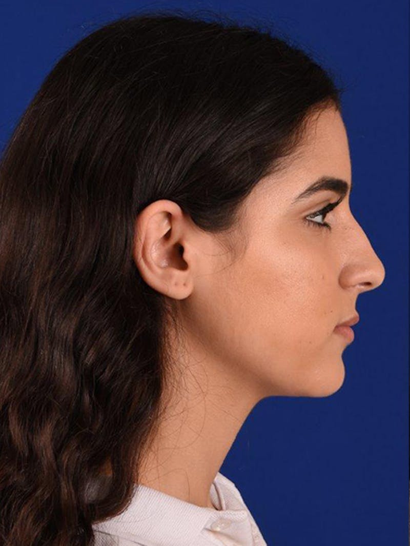 Female Rhinoplasty Before & After Gallery - Patient 17363868 - Image 5