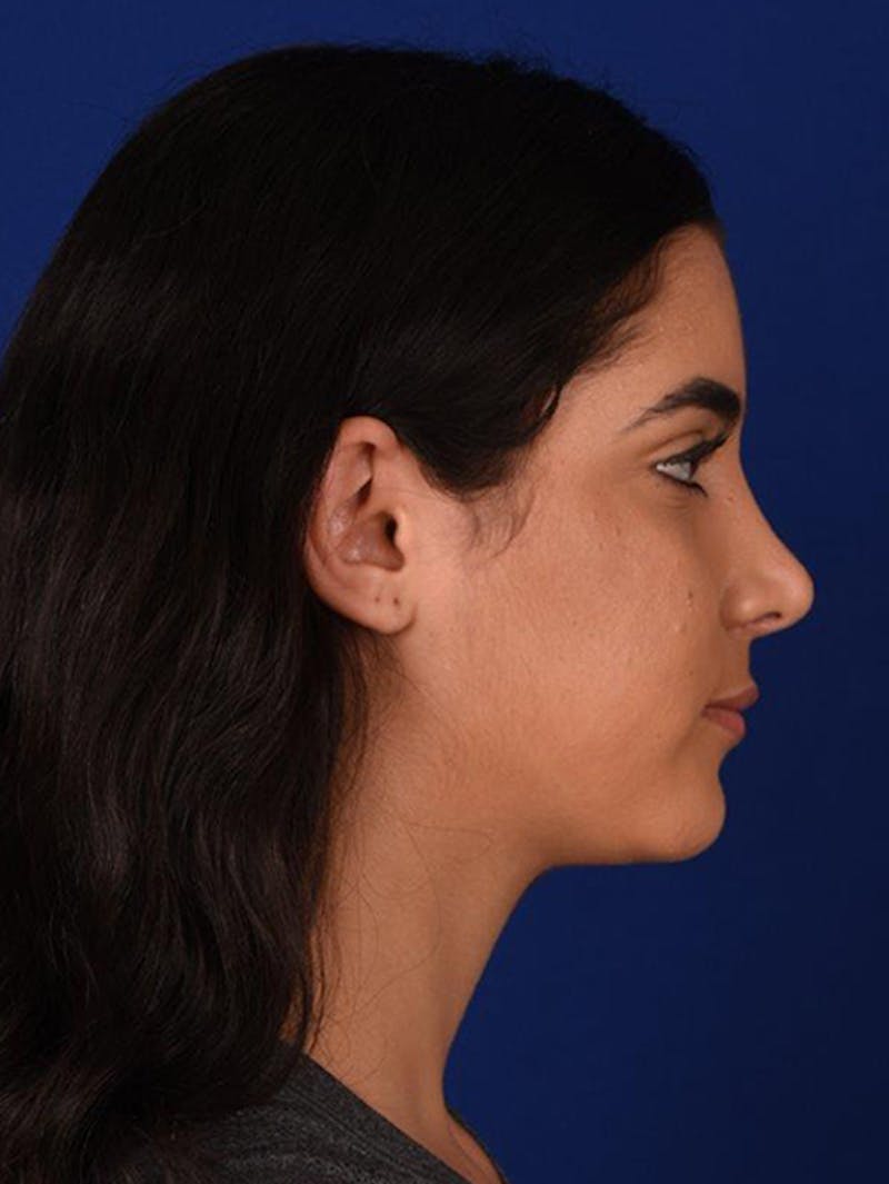 Female Rhinoplasty Before & After Gallery - Patient 17363868 - Image 6