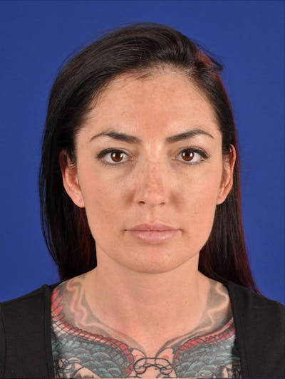 Female Rhinoplasty Before & After Gallery - Patient 17363875 - Image 1