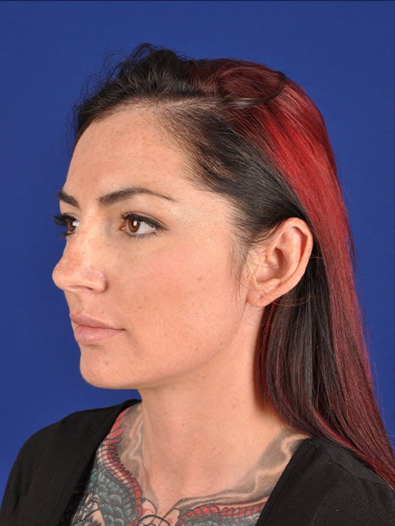 Female Rhinoplasty Before & After Gallery - Patient 17363875 - Image 3