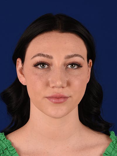 Female Rhinoplasty Before & After Gallery - Patient 17363877 - Image 2
