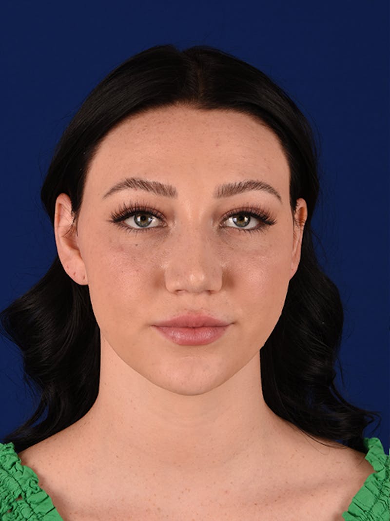 Female Rhinoplasty Before & After Gallery - Patient 17363877 - Image 2