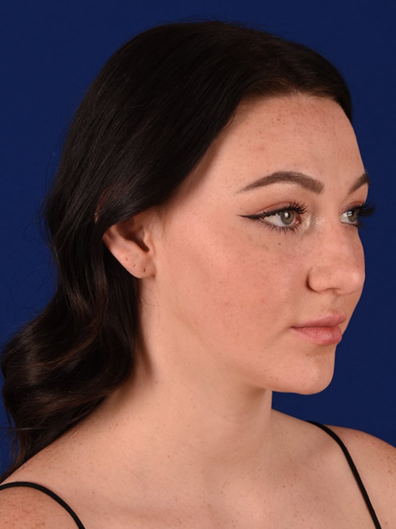 Female Rhinoplasty Before & After Gallery - Patient 17363877 - Image 3