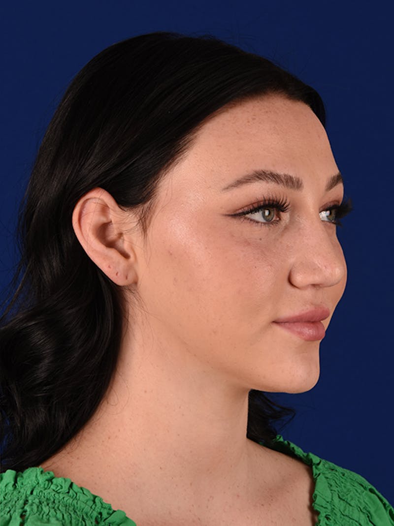 Female Rhinoplasty Before & After Gallery - Patient 17363877 - Image 4