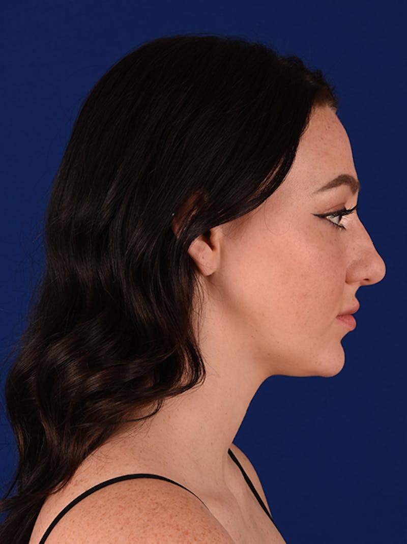 Female Rhinoplasty Before & After Gallery - Patient 17363877 - Image 5