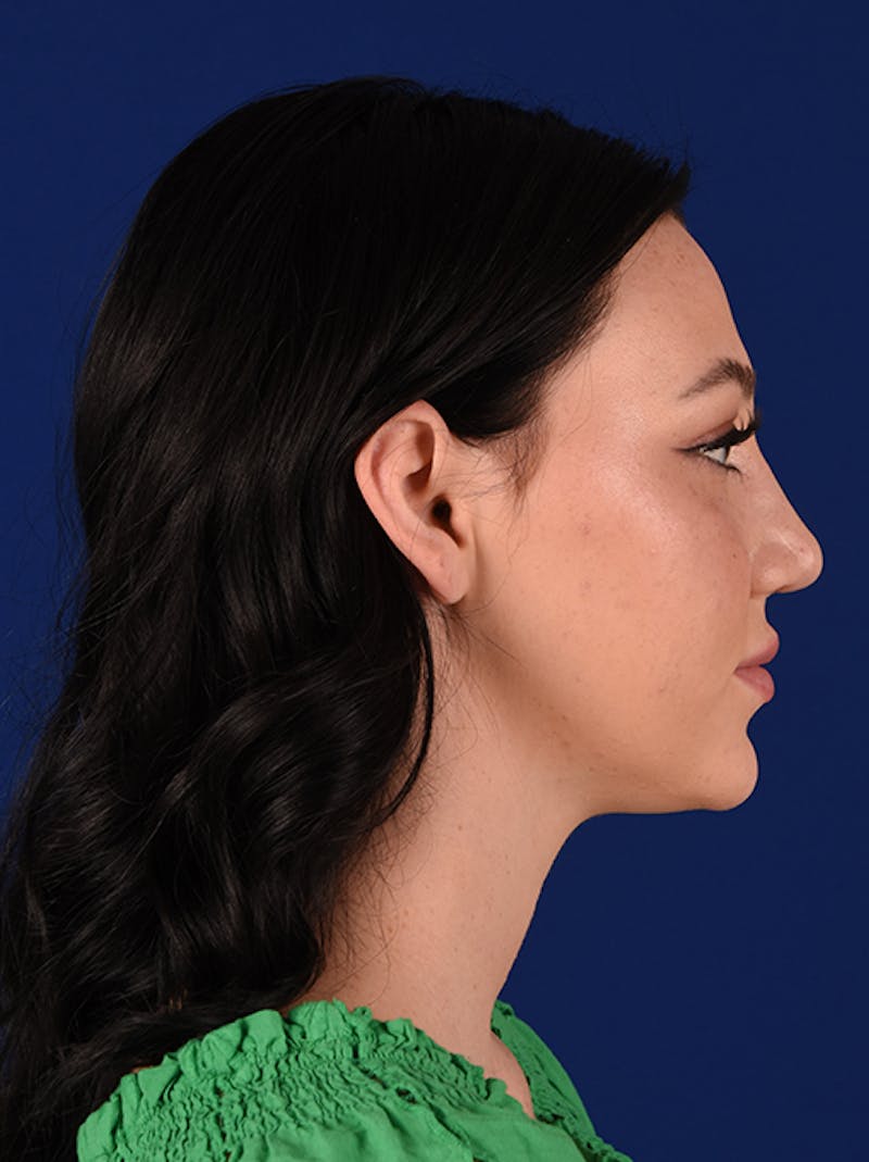 Female Rhinoplasty Before & After Gallery - Patient 17363877 - Image 6