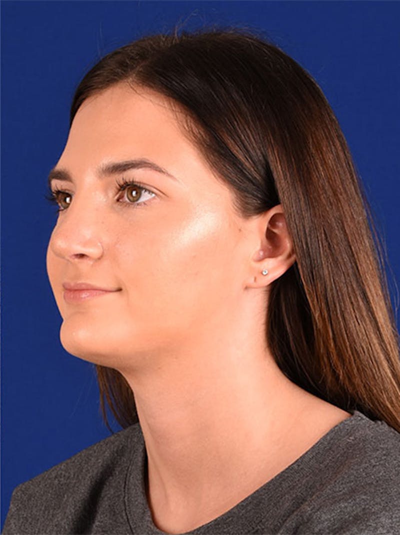 Female Rhinoplasty Before & After Gallery - Patient 17363878 - Image 4