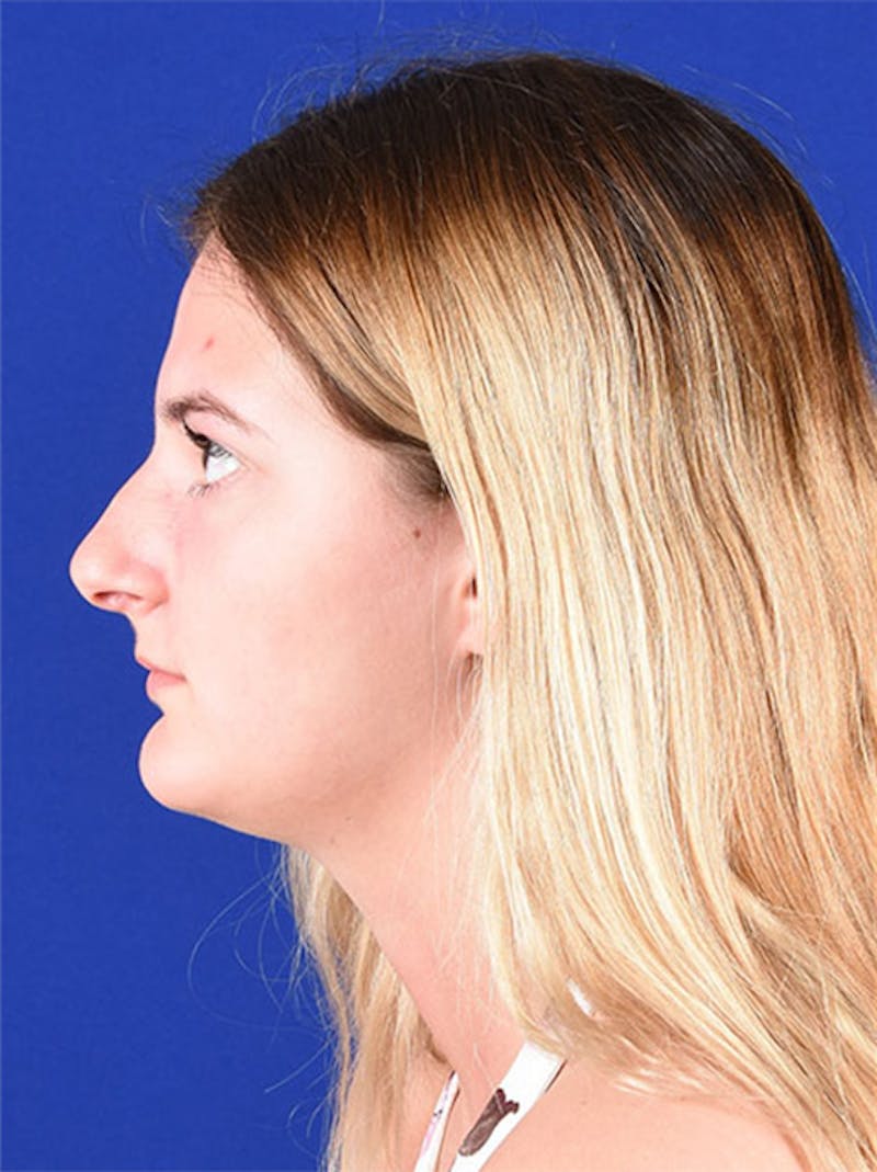 Female Rhinoplasty Before & After Gallery - Patient 17363878 - Image 5